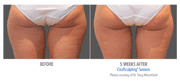 Thighs Before & After